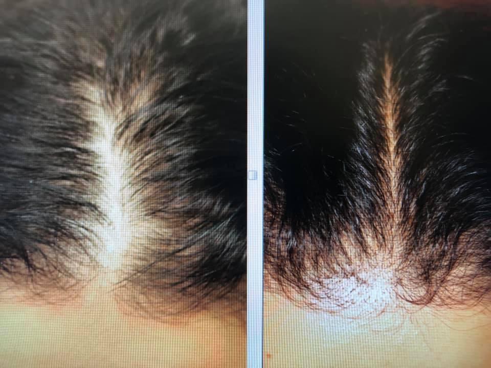 Hair Restoration for Women and Men | Rejeune MD Wellness and Aesthetics
