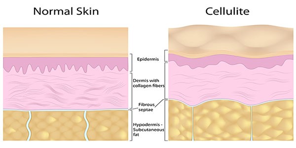 Cellulite Treatment in Pewaukee, WI